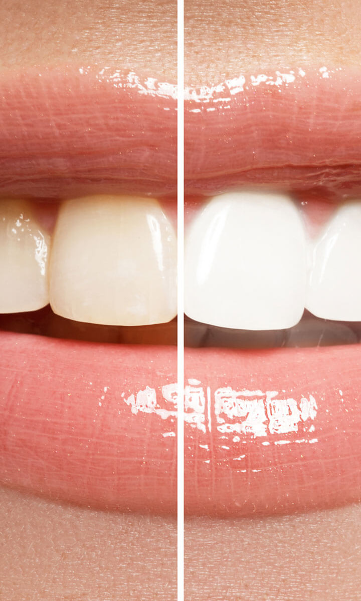 Veranschaulichung Zahnaufhellung mittels Bleaching