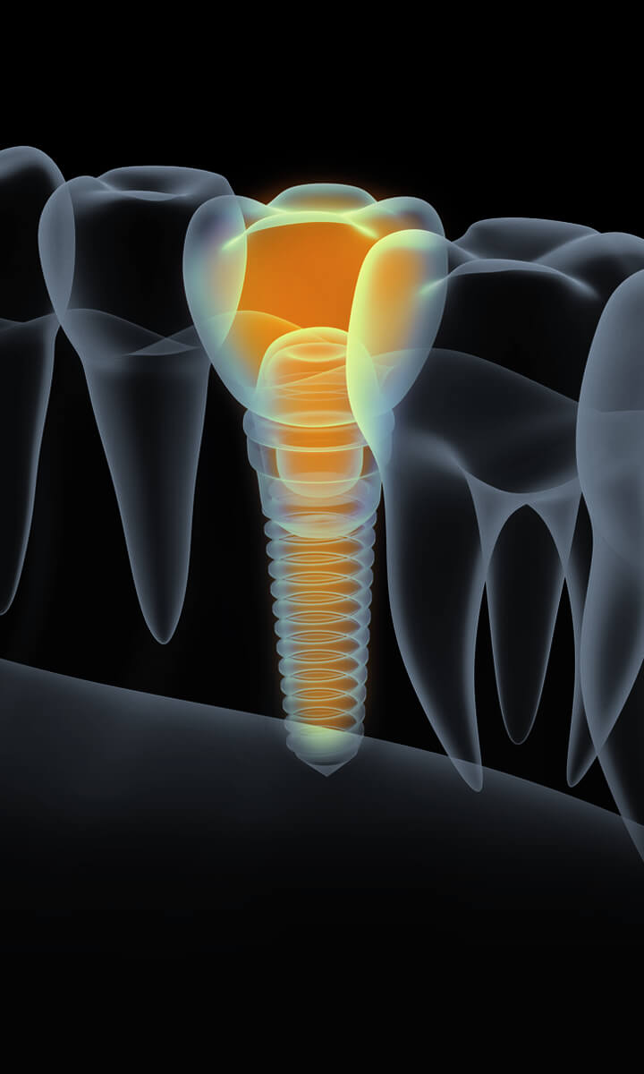 Stilisirte 3D-Darstellung eines Zahnimplantates Mannheim